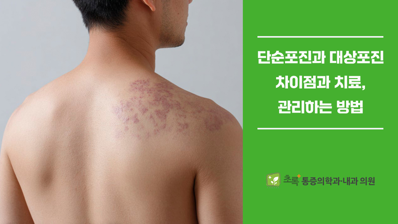 피곤할 때 입술 물집 수포 단순포진과 대상포진의 차이와 치료 및 관리법
