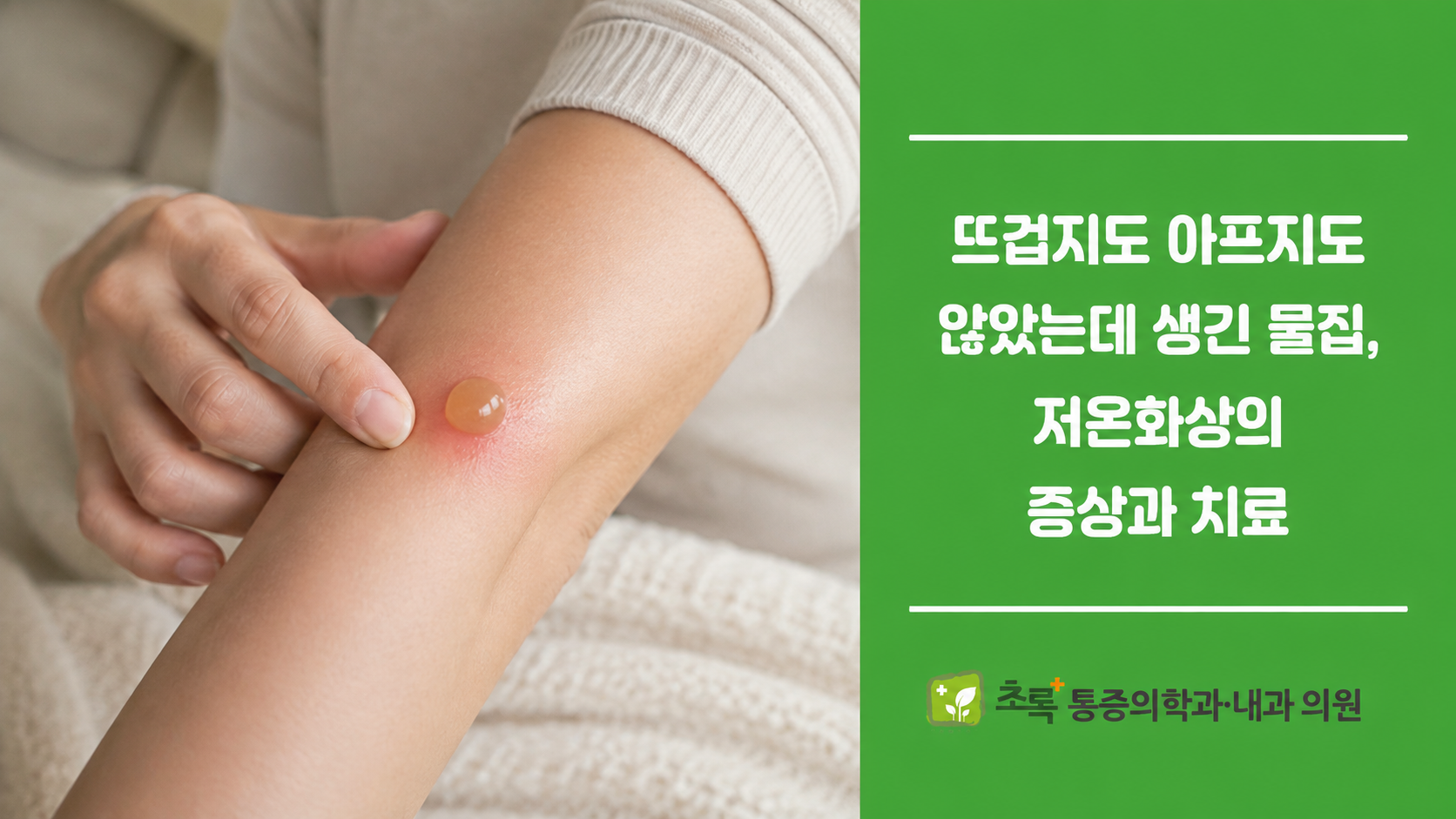 뜨겁지도 아프지도 않았는데 생긴 물집, 저온화상의 증상과 치료